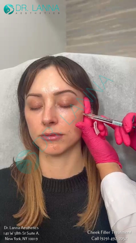cheek filler treatment
