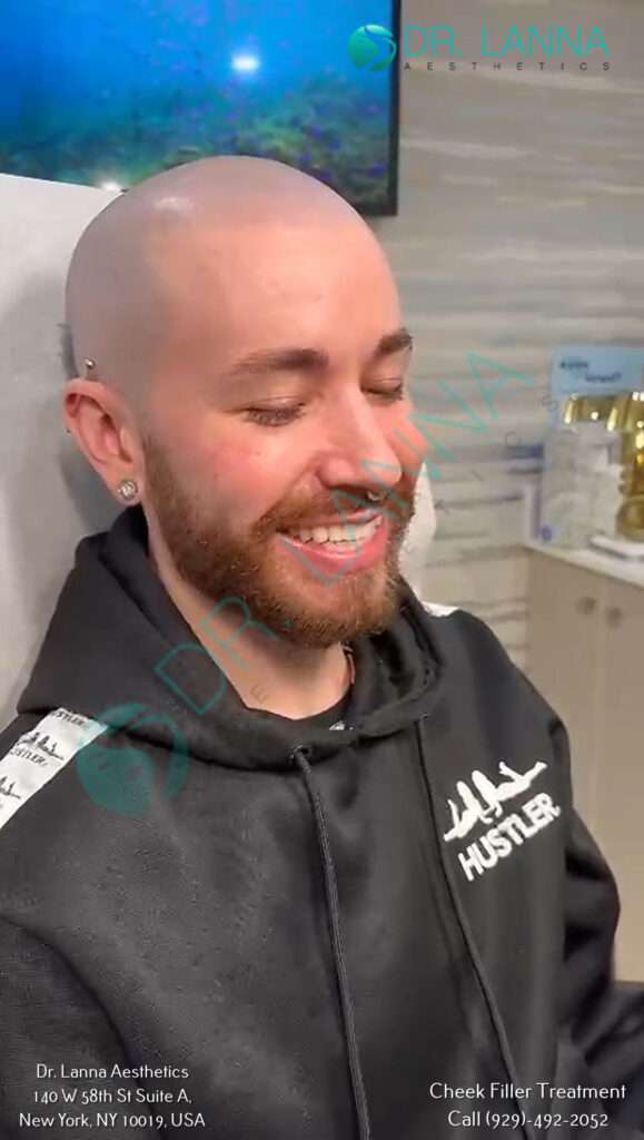 a man's face after cheek filler treatment