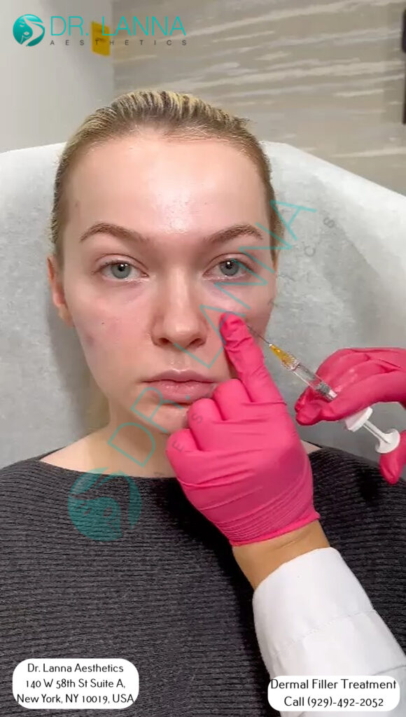 a woman received cheek filler treatment at Dr. Lanna's clinic