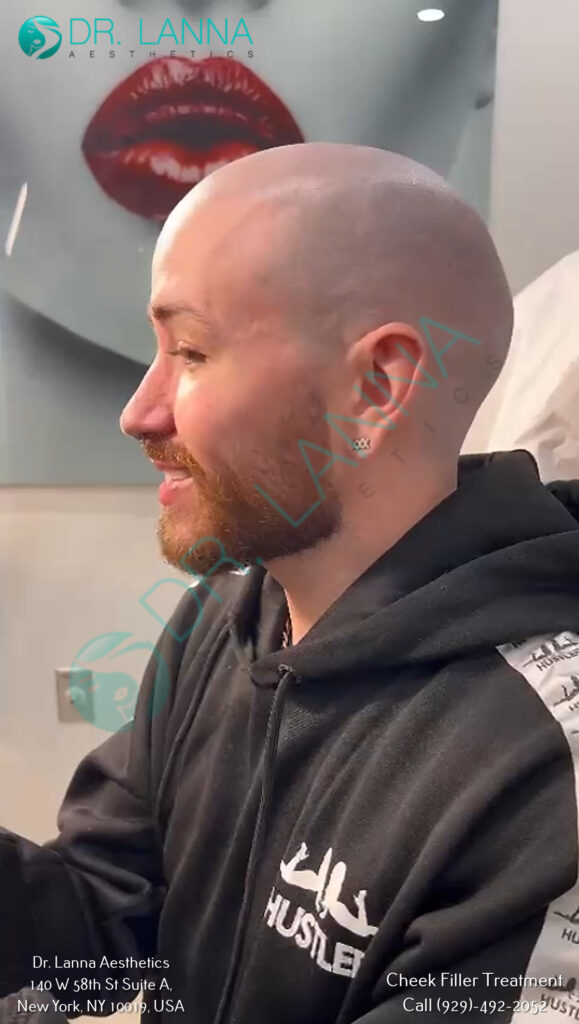 a man's face after cheek filler treatment