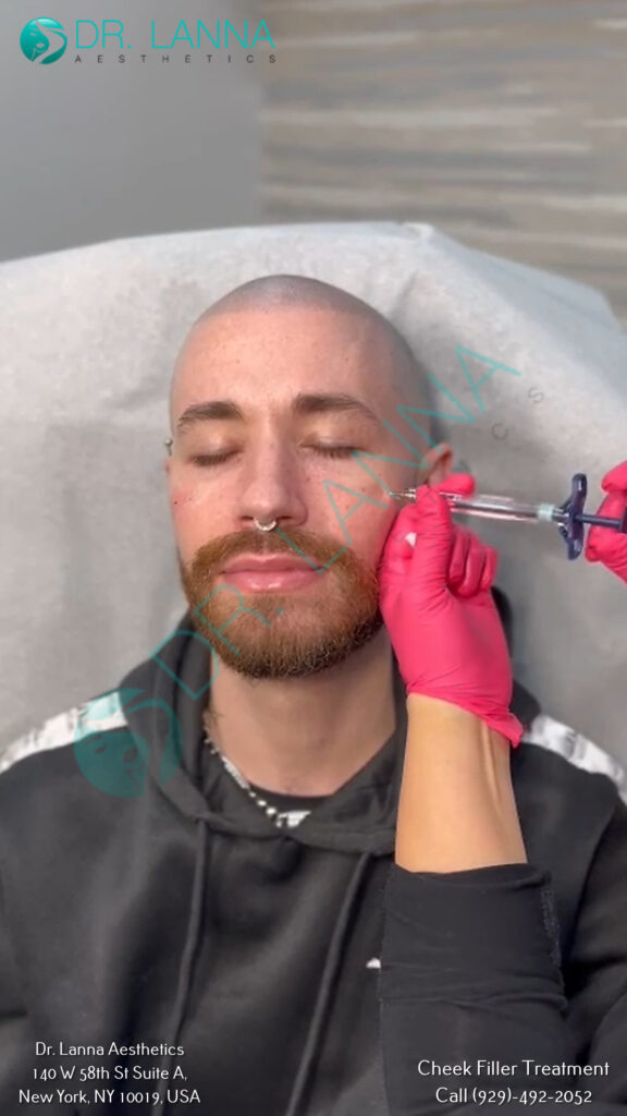 Cheek Filler Treatment at Dr. Lanna Aesthetics