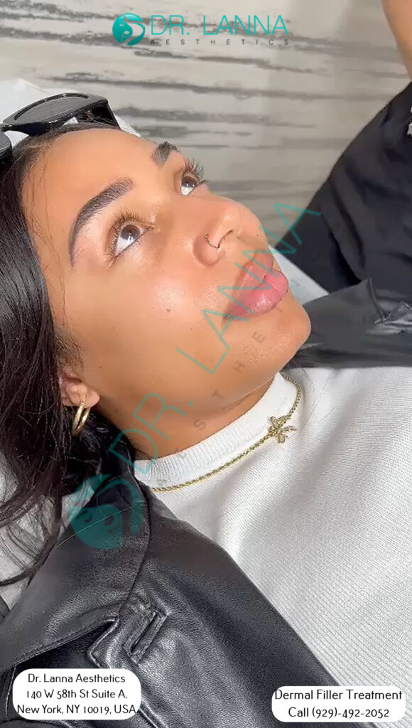 a patient had cheek filler procedure at Dr. Lanna's clinic