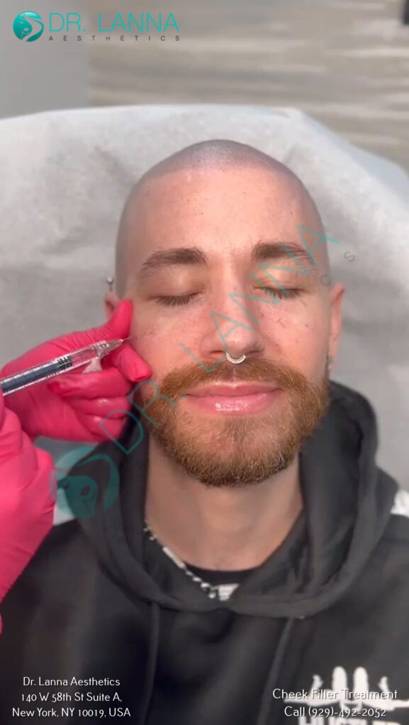 cheek filler treatment