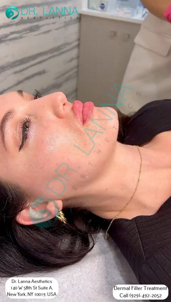 a woman had cheek filler treatment at Dr. Lanna's clinic