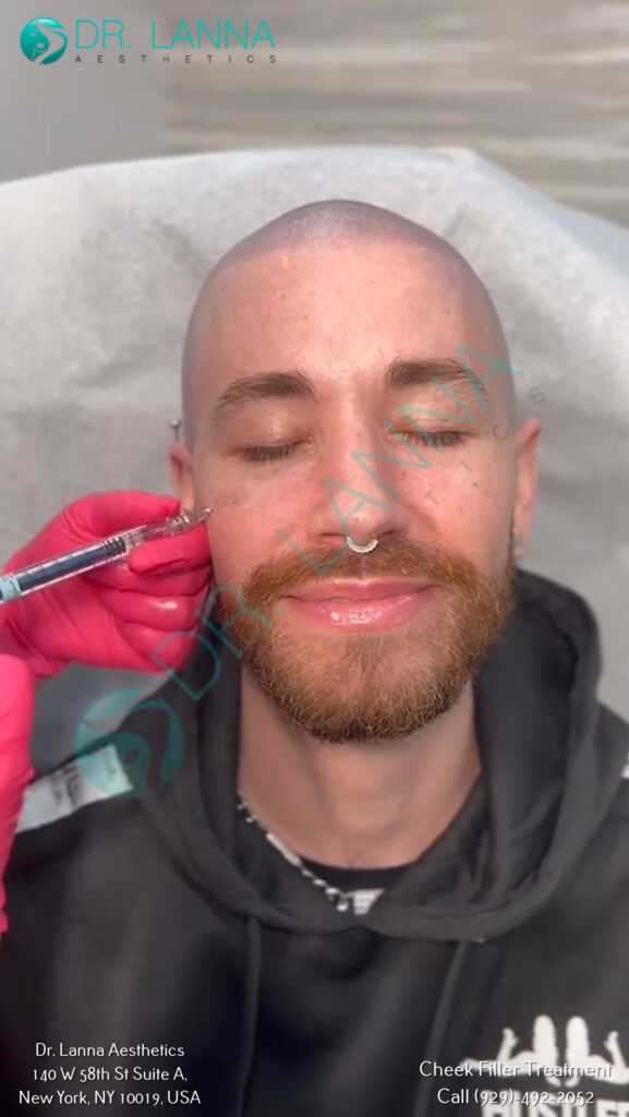 Bearded male client receiving lateral cheek filler at Dr. Lanna Aesthetics, NYC