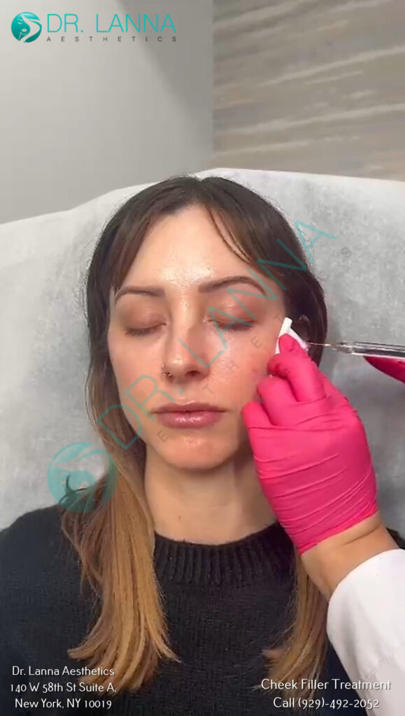 Client receiving a cheek filler treatment at Dr. Lanna Aesthetics, NYC