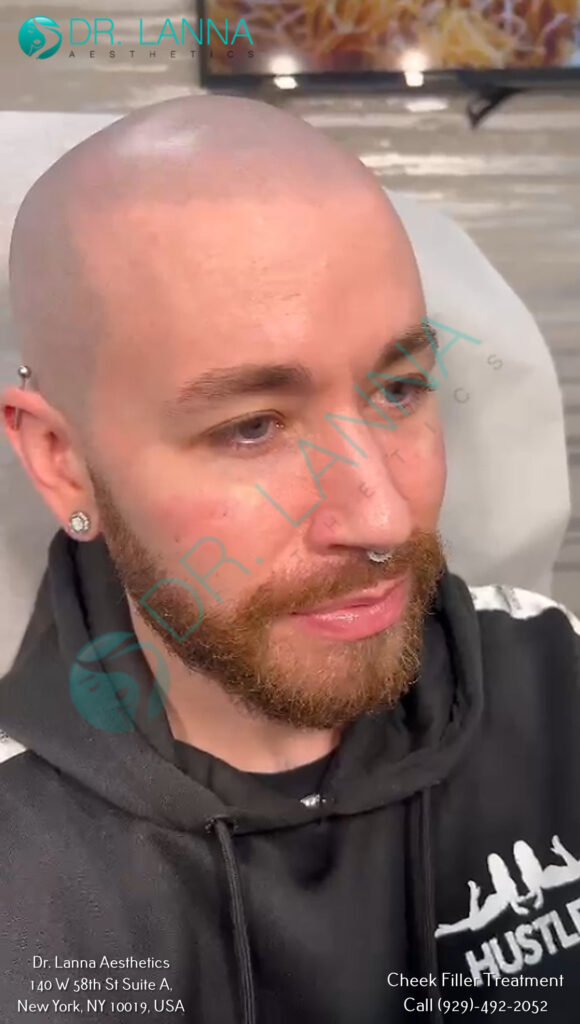 a man getting cheek filler treatment