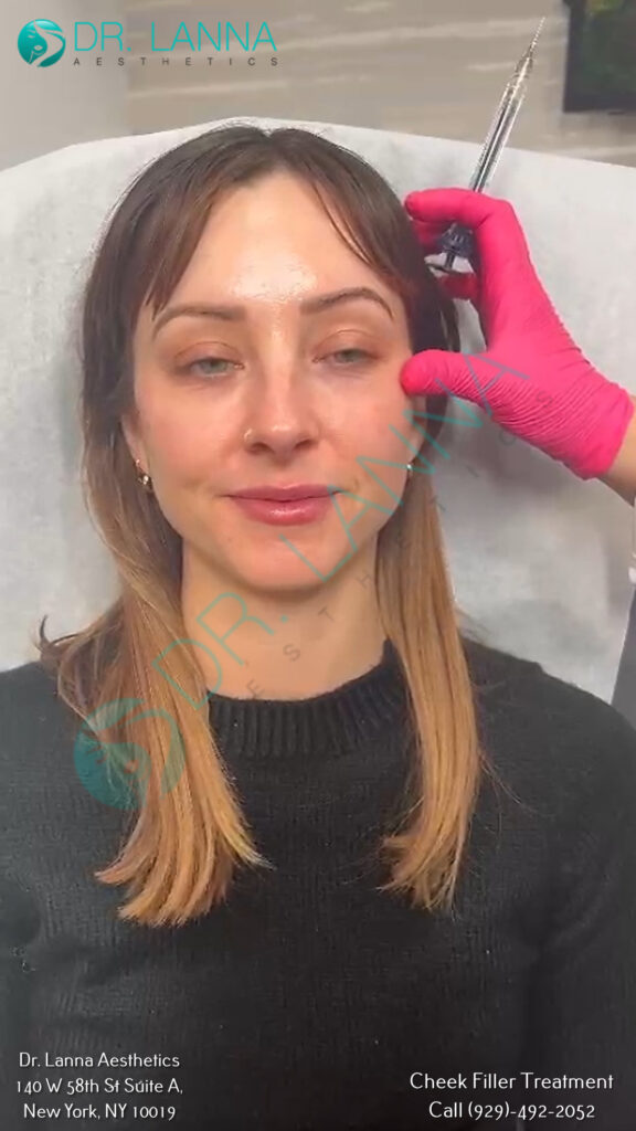 Client receiving a cheek filler treatment with a pen at Dr. Lanna Aesthetics, NYC