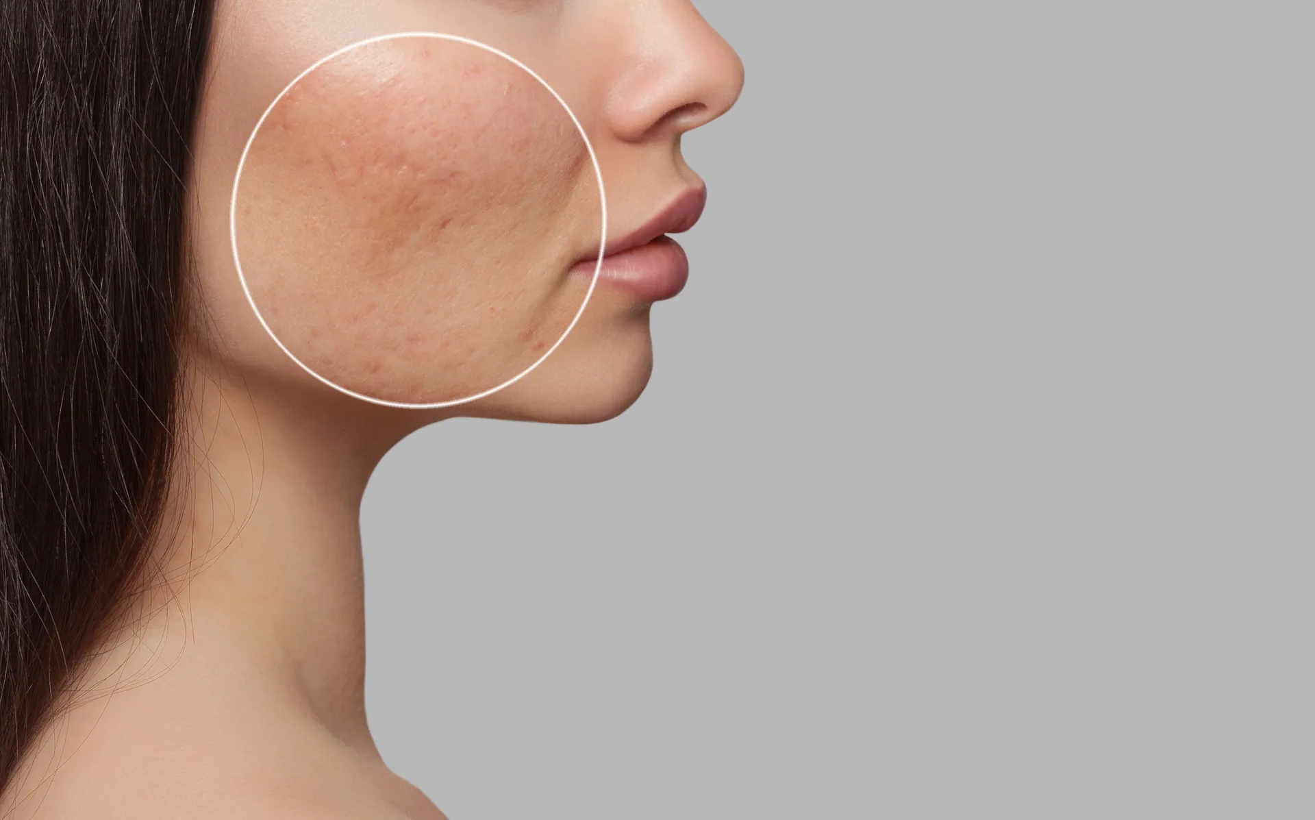 Acne Scar Removal at Dr. Lanna Aesthetics