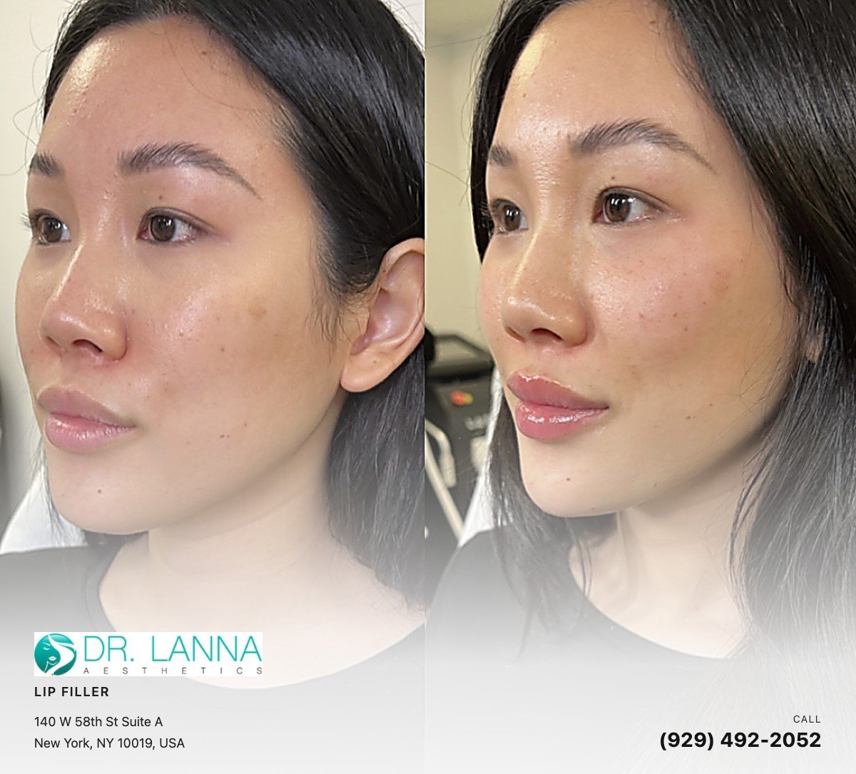 Lip Filler treatment at Dr. Lanna Aesthetics in New York, NY