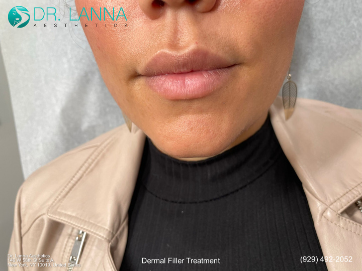 swelling last after the woman's chin filler treatment