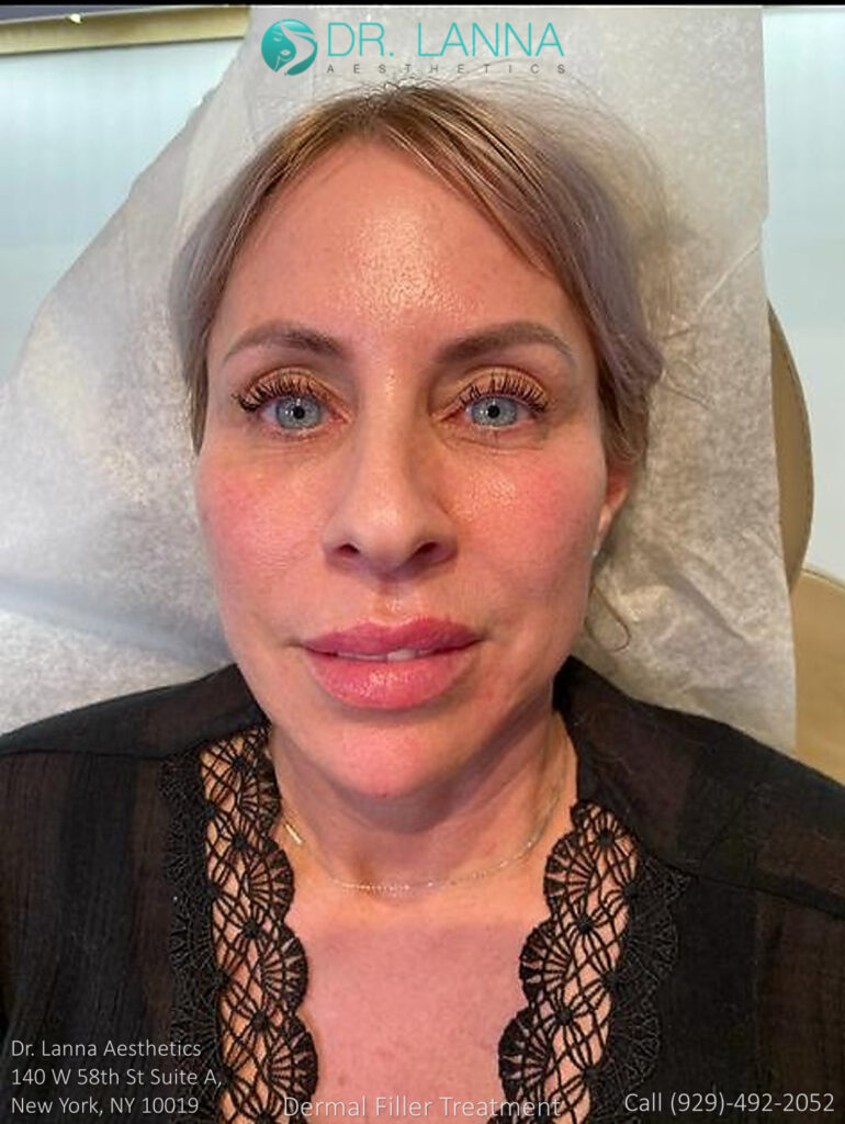 woman who undergo cheek filler procedure in Dr. Lanna's clinic