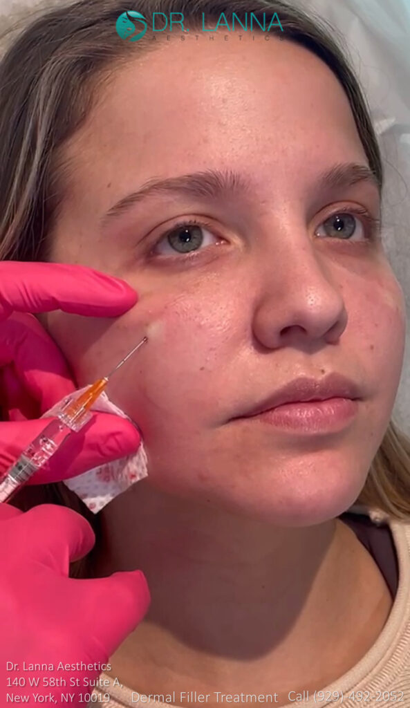 young woman received cheek filler treatment