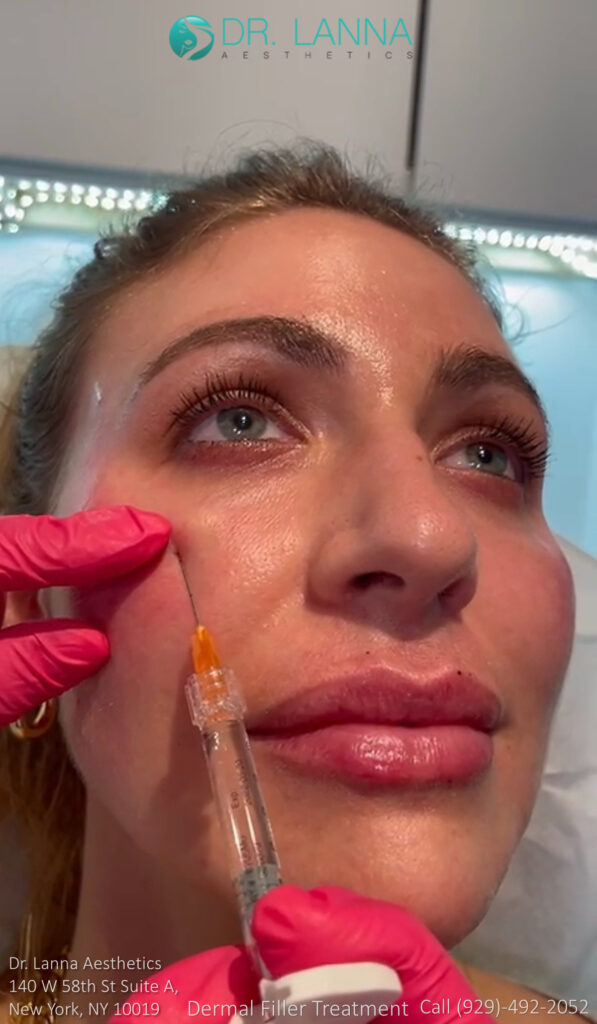 middle aged woman had cheek filler procedure