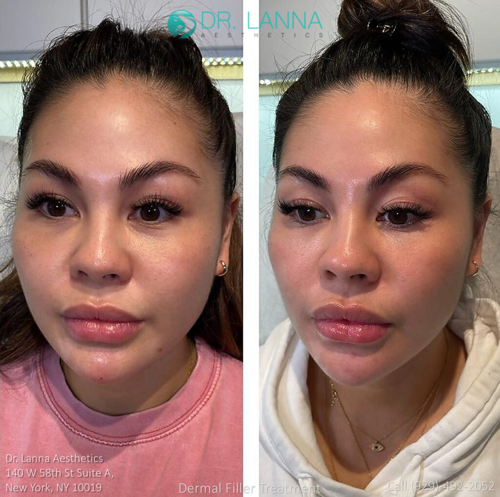 a woman who had cheek filler procedure in Dr. Lanna's beauty clinic