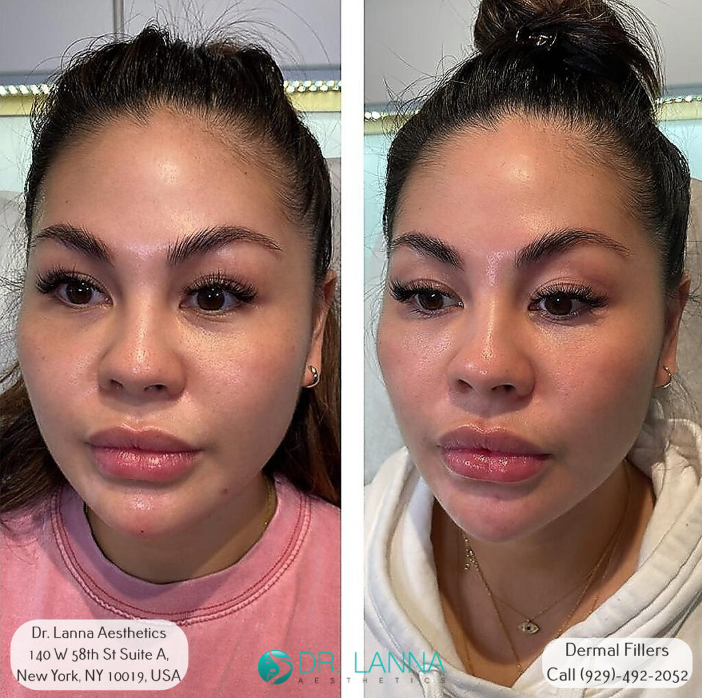 woman who received cheek filler treatment at Dr. Lanna's beauty clinic