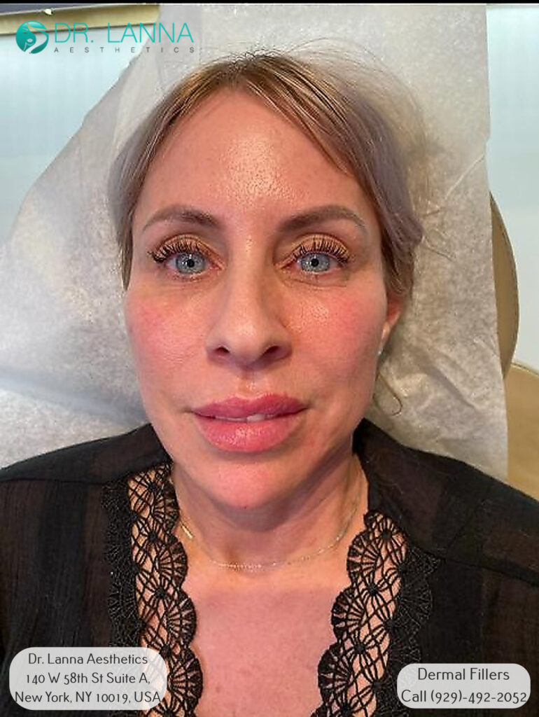 middle aged woman after getting chin filler treatment