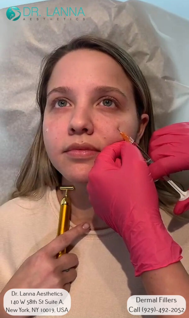 woman receives cheek filler injection to enhance her beauty at Dr. Lanna's clinic