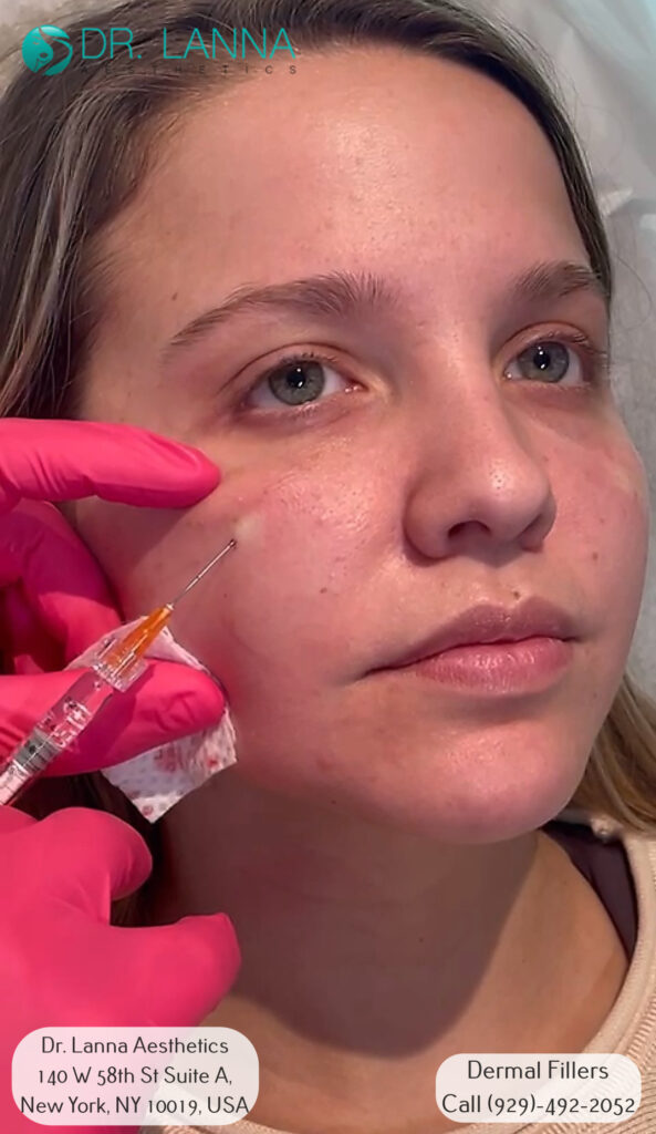 a woman gets cheek filler injections at Dr. Lanna's beauty clinic