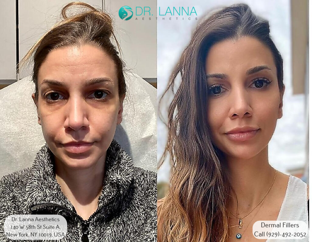 woman gets cheek filler injections at Dr. Lanna's beauty clinic