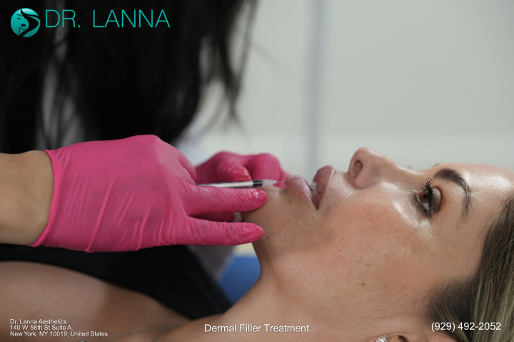 woman had lip filler procedure at Dr. Lanna Aesthetics' beauty clinic