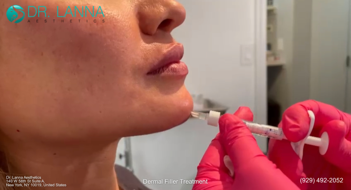 a woman undergoes dermal filler treatment on the chin area