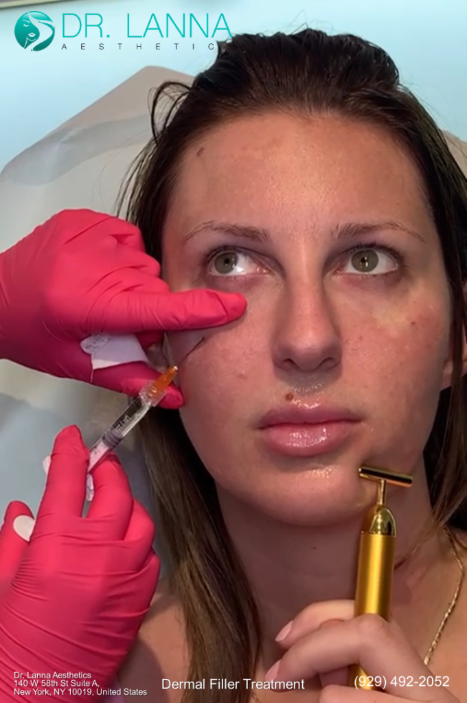 woman receives dermal filler treatment under her eyes at Dr. Lanna Aesthetics' beauty clinic