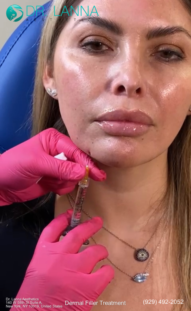 a woman had dermal filler injections at Dr. Lanna Aesthetics' beauty clinic