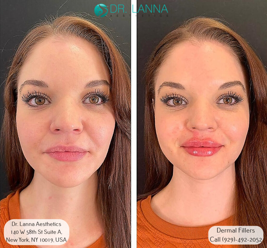 woman's before and after resuls after dermal filler procedure at Dr. Lanna Aesthetics' beauty clinic