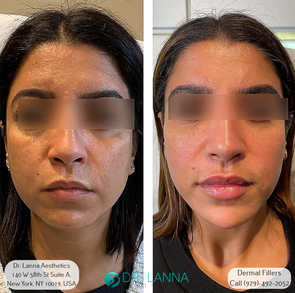 portrait of a woman before and after results on getting dermal fillers treatment