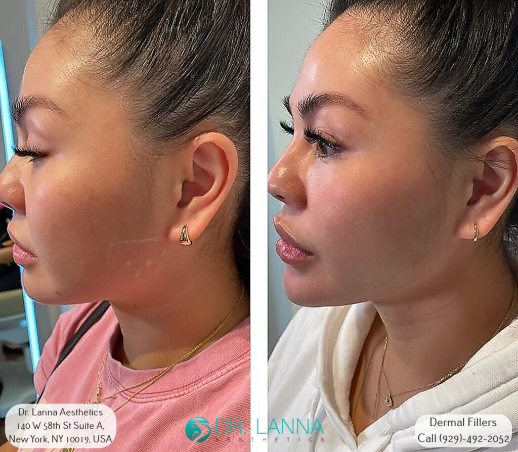 a woman had dermal filler treatment at Dr. Lanna Aesthetics' beauty clinic