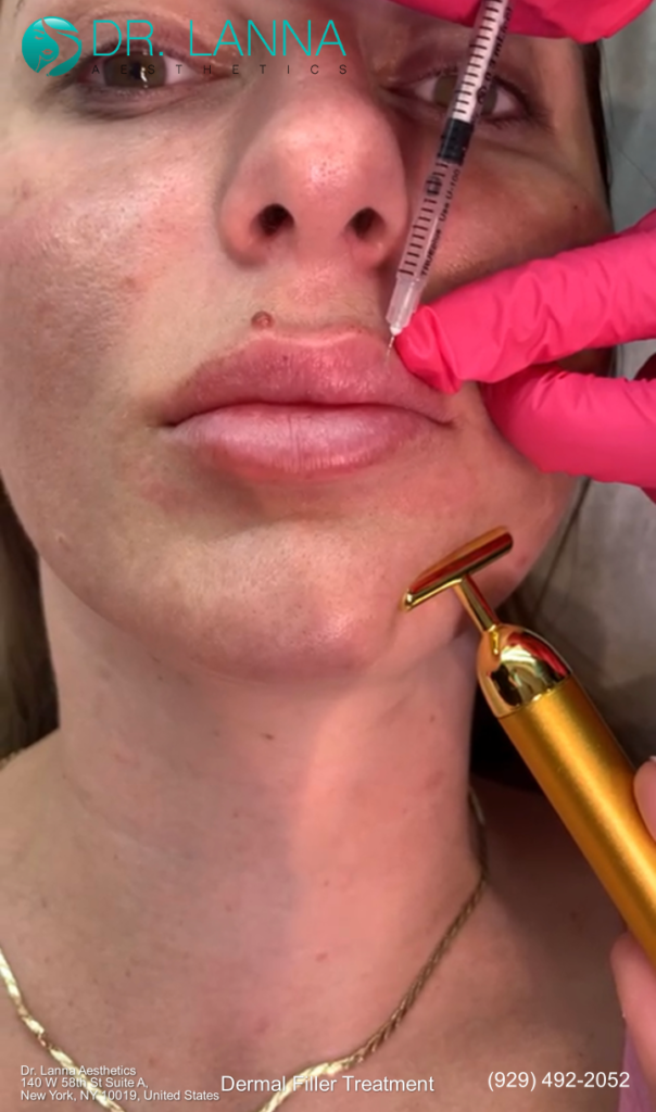 a woman undergoes dermal filler procedure at Dr. Lanna Aesthetics' beauty clinic