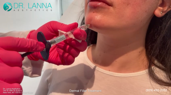 a woman received dermal filler treatment on her chin at Dr. Lanna's clinic