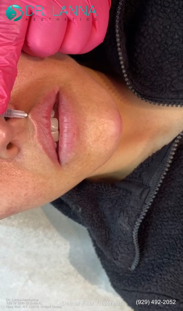 a woman gets lip filler at Dr. Lanna's clinic