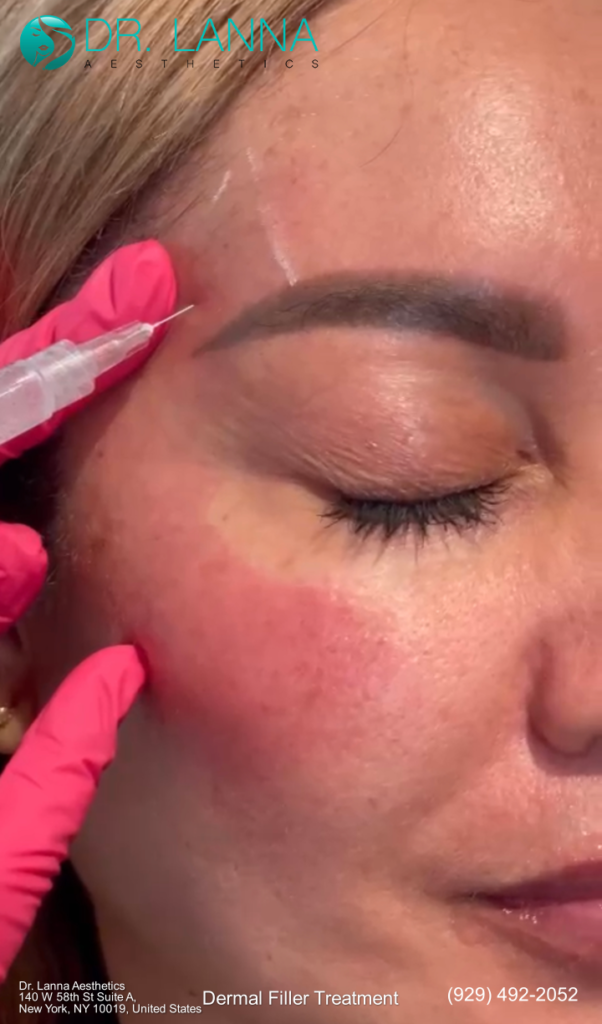 a woman had dermal filler treamtent on the brows