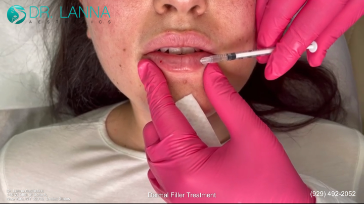 a woman received lip filler treatment at Dr. Lanna's clinic