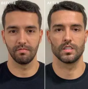 how-jawline-fillers-can-helpfinal-298x300