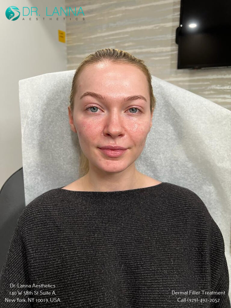 a woman received dermal filler treatment for her eyes