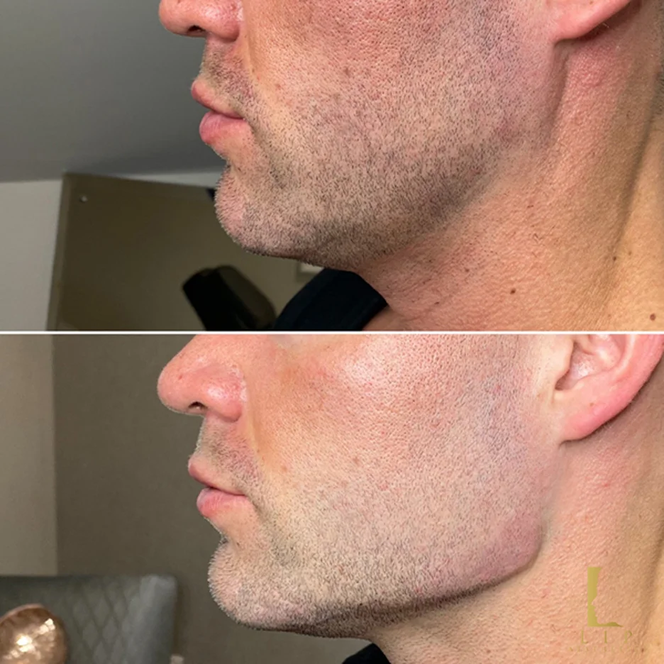jaw-filler-male2