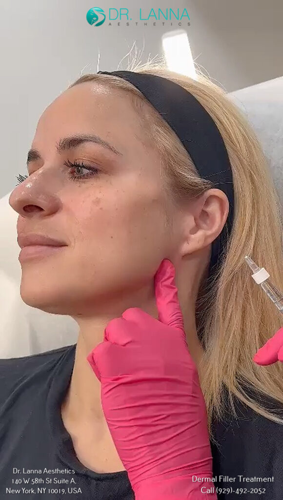 a woman received dermal fillers on her jawline at Dr. Lanna's clinic