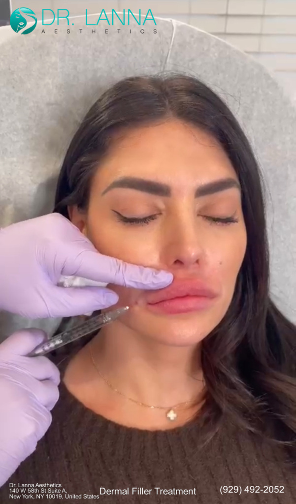 a woman got her dermal filler injections at Dr. Lanna's clinic