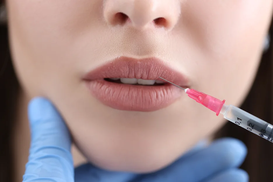 a woman received lip filler treatment
