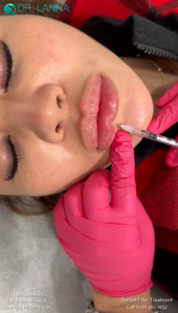 a woman had lip filler procedure at Dr. Lanna's clinic