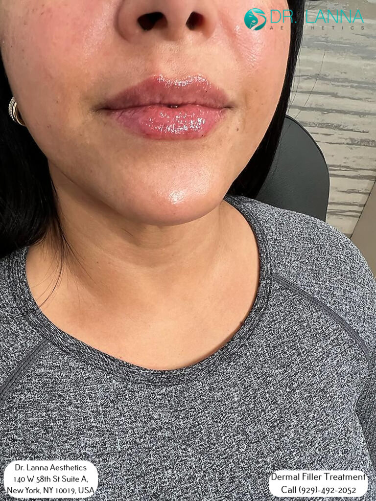 a woman received dermal filler injections on her lips inside Dr. Lanna's clinic