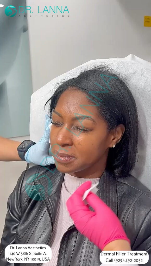 a woman received cheek filler injections at Dr. Lanna's clinic