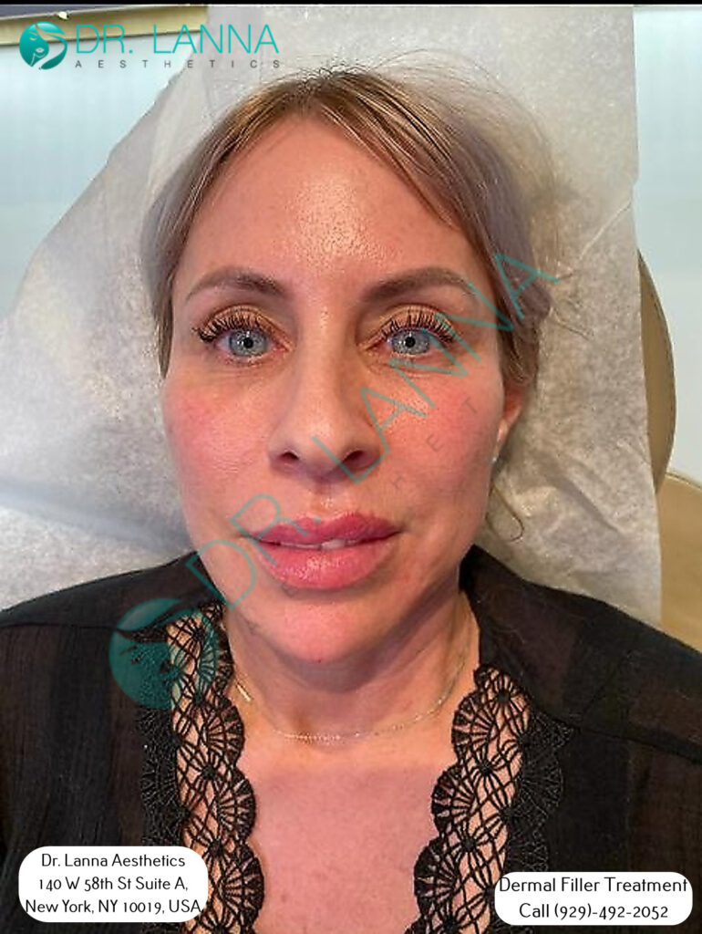 a matured woman had cheek filler treatment at Dr. Lanna's clinic