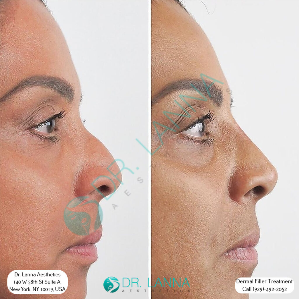 before and after image of a woman who underwent cheek filler procedure at Dr. Lanna's clinic