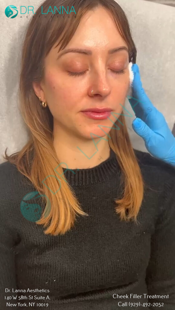 a woman having cheek filler treatment
