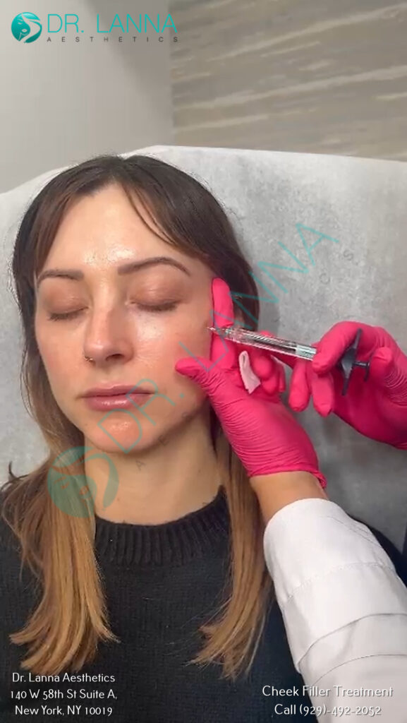 A Woman Getting Cheek Fillers at Dr. Lanna Aesthetics